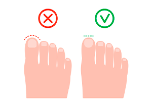 6 Как избежать проблемы вросшего ногтя